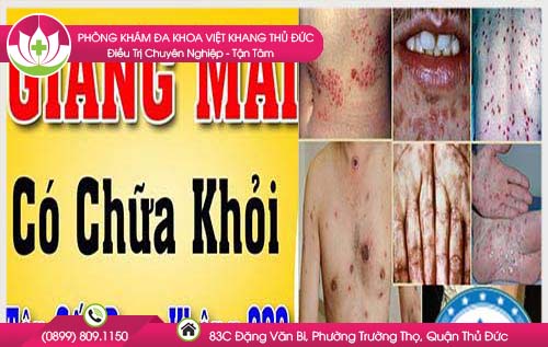 benh-giang-mai-co-chua-duoc-khong