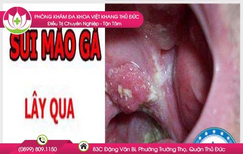 benh-sui-mao-ga-co-lay-qua-duong-mieng